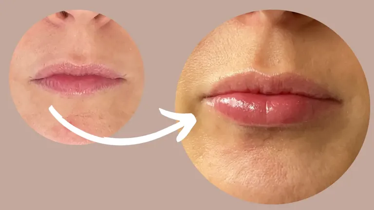 lip fillers