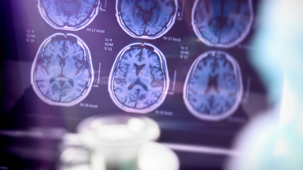 Surprising Facts About Alzheimer's Disease