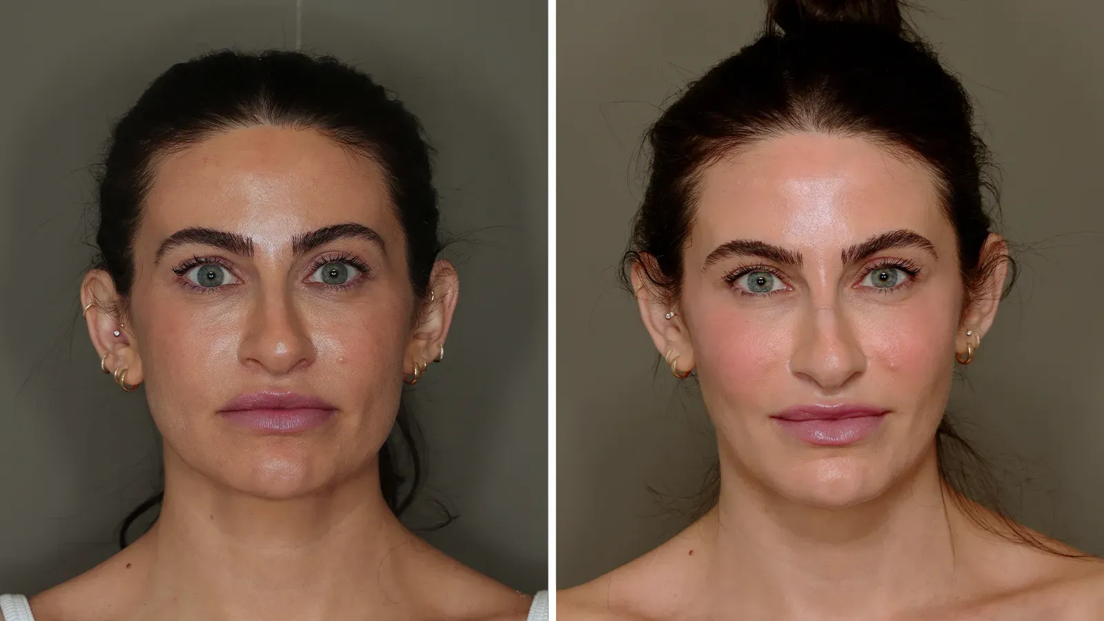 Bruising after fat transfer