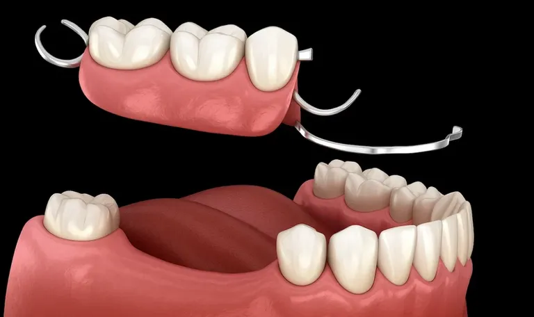 Fixed vs. removable tooth replacements