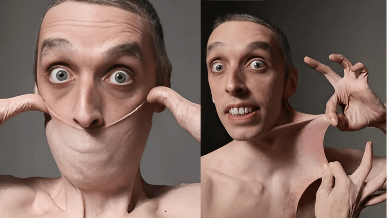 Garry Stretch Turner demonstrates his Guinness World Record for the world's stretchiest skin caused by Ehlers-Danlos syndrome