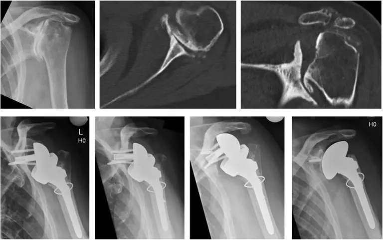 Total shoulder replacement vs spinal conditions