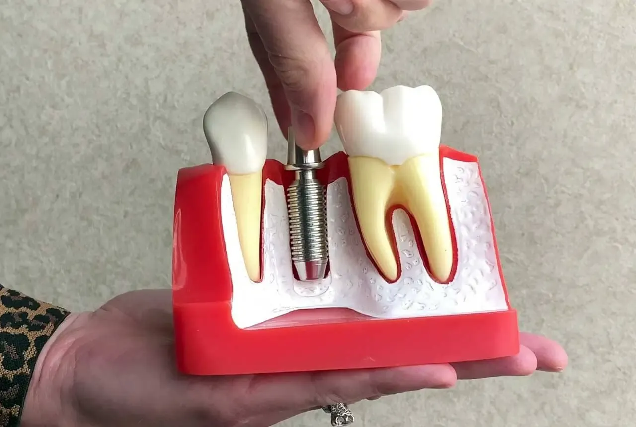 Dental implants in Indianapolis