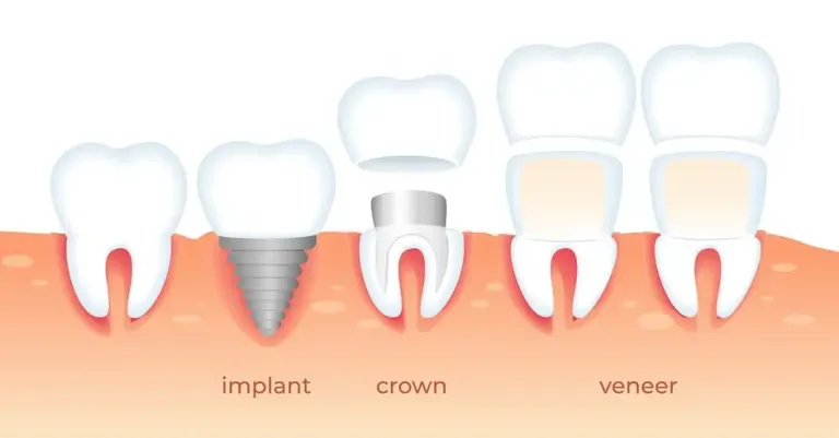 Implants or veneers