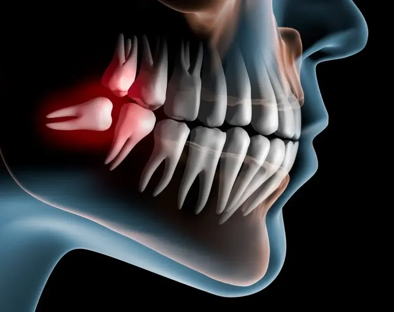 Impacted wisdom tooth