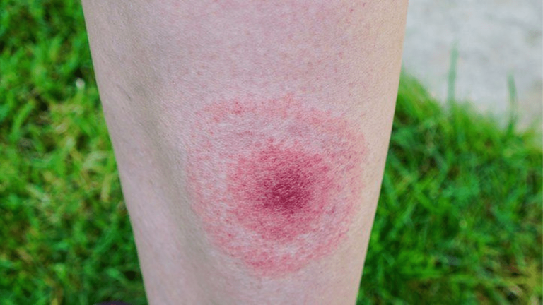 New Tick-borne virus from Canada killed Maryland citizen This is the first-ever case in the State