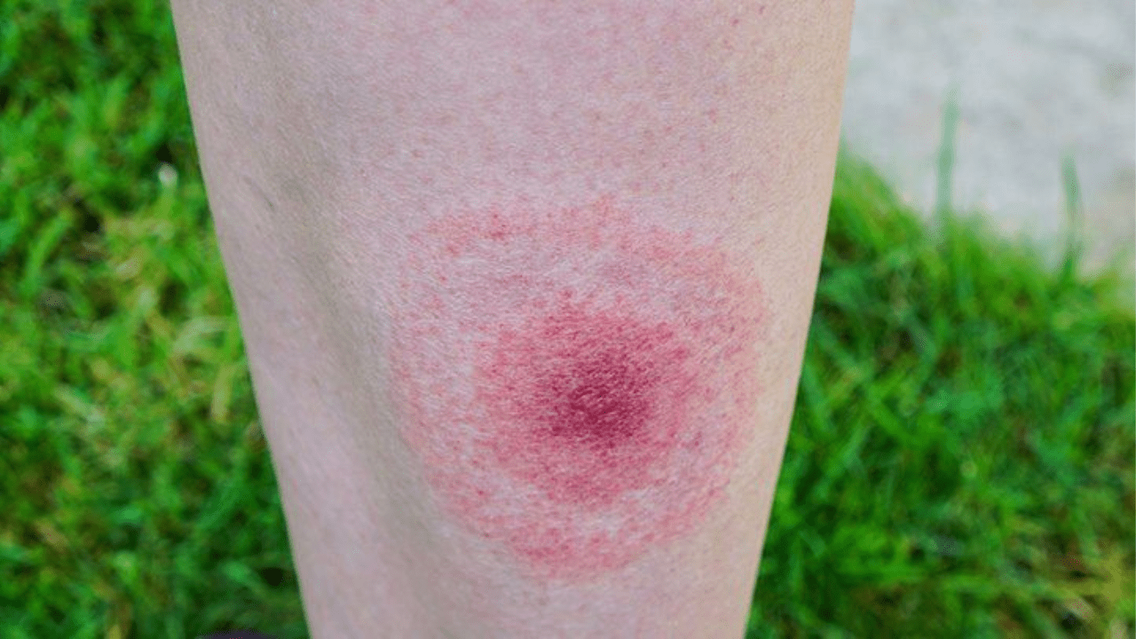 New Tick-borne virus from Canada killed Maryland citizen This is the first-ever case in the State