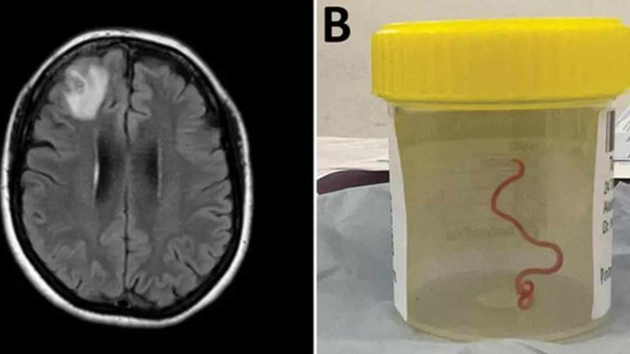 Surgeons remove live worm from Australian woman's brain for first time ever