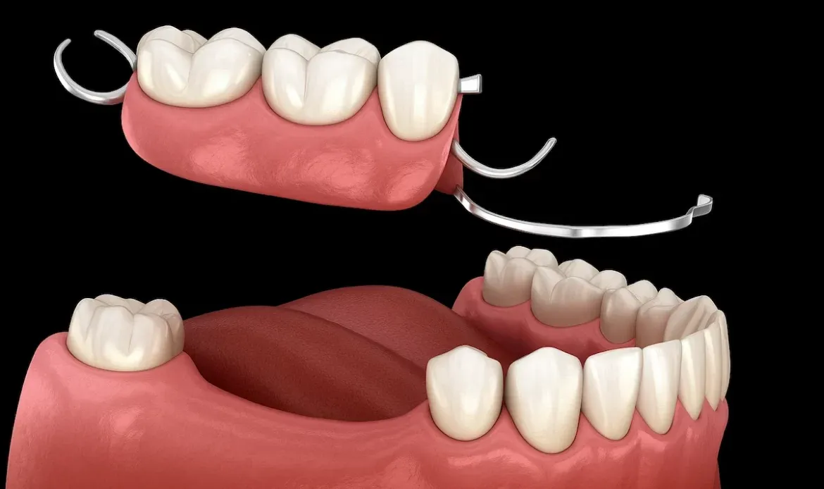 Fixed vs. removable tooth replacements